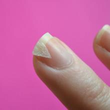 Por qué las uñas se pelan y qué hacer al respecto Motivo por el que las uñas se pelan gravemente